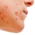 Can Botox Help Treat Hormonal Acne?