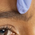 Can You Share Botox? The Benefits of Combining Botox and Dermal Fillers