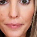 How Long Does Droopy Eyelids Last After Botox Treatment?