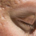 Can Botox Injections Cause Skin Problems?