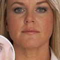 How Long Does Nerve Damage from Botox Last?