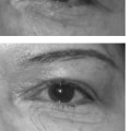 Treating Botox Ptosis: A Comprehensive Guide