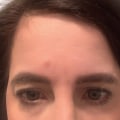 Does Dysport Last as Long as Botox?