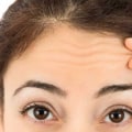 What Areas Should You Avoid When Taking Botox?