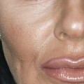 Can Botox Be Used Anywhere?
