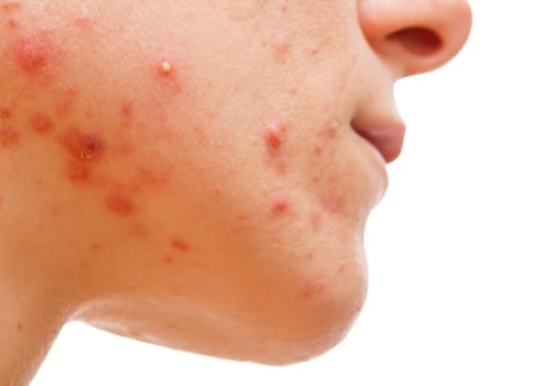 Can Botox Help Treat Hormonal Acne?