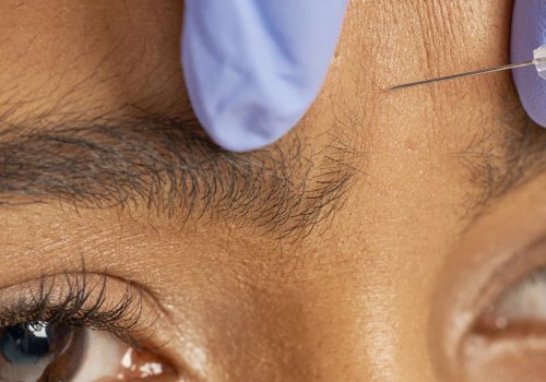 Can You Share Botox? The Benefits of Combining Botox and Dermal Fillers