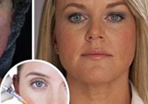How Long Does Nerve Damage from Botox Last?