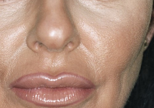 Is Botox Suitable for Everyone? A Comprehensive Guide