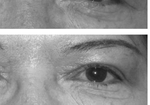 Treating Botox Ptosis: A Comprehensive Guide