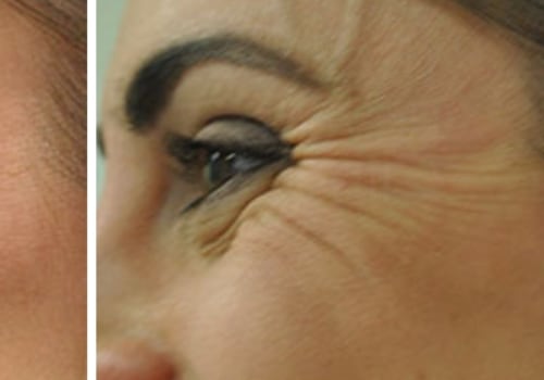 3 Best Areas for Botox Treatment
