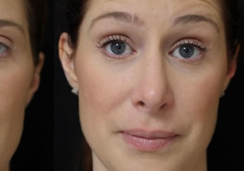 Are Botox and Dysport the Same Thing?