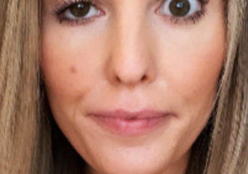 How Long Does a Droopy Eyelid Last After Botox Treatment?